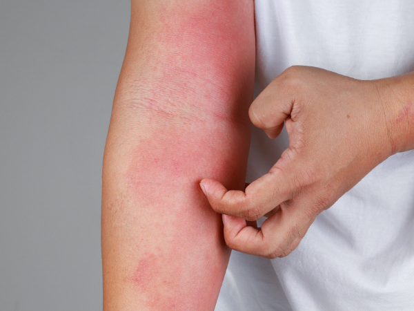 Gut Health and Skin: Understanding Dermatitis